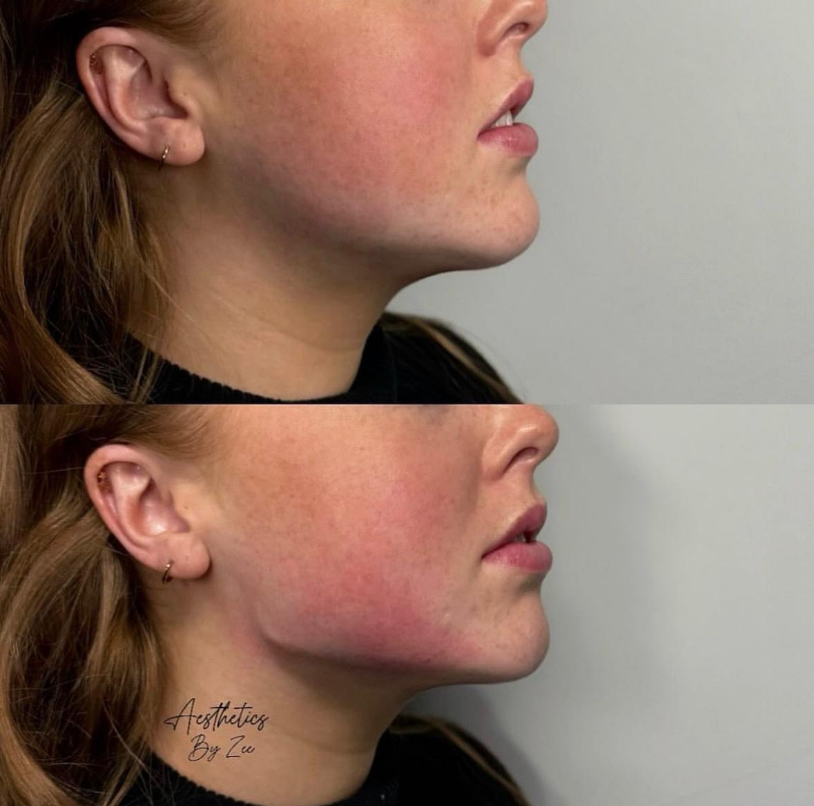 Jawline Contouring