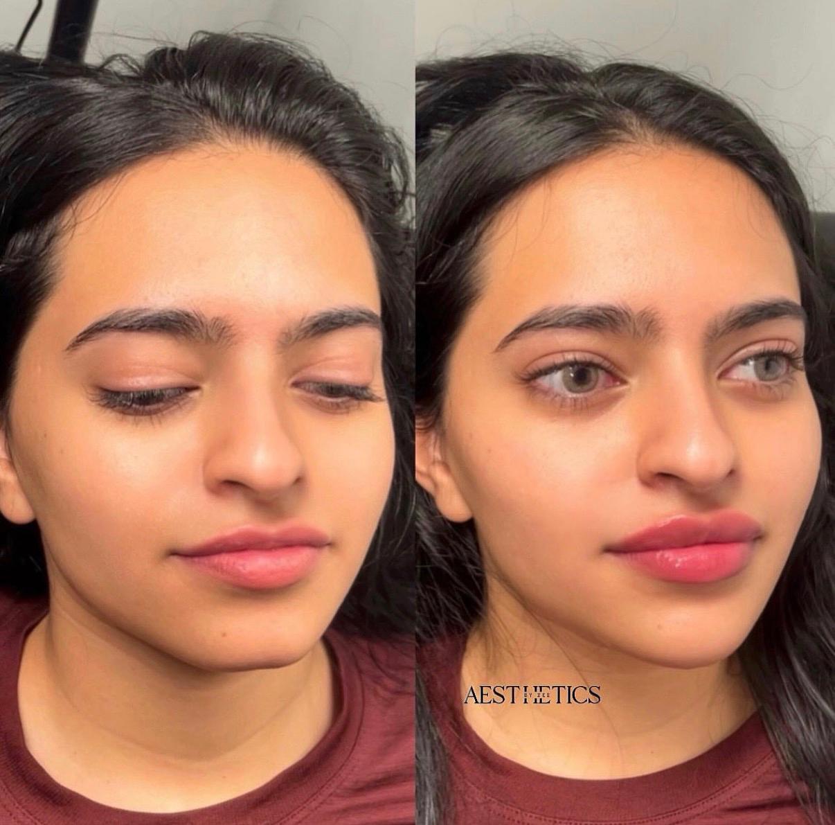 Cheek & Lip Enhancement