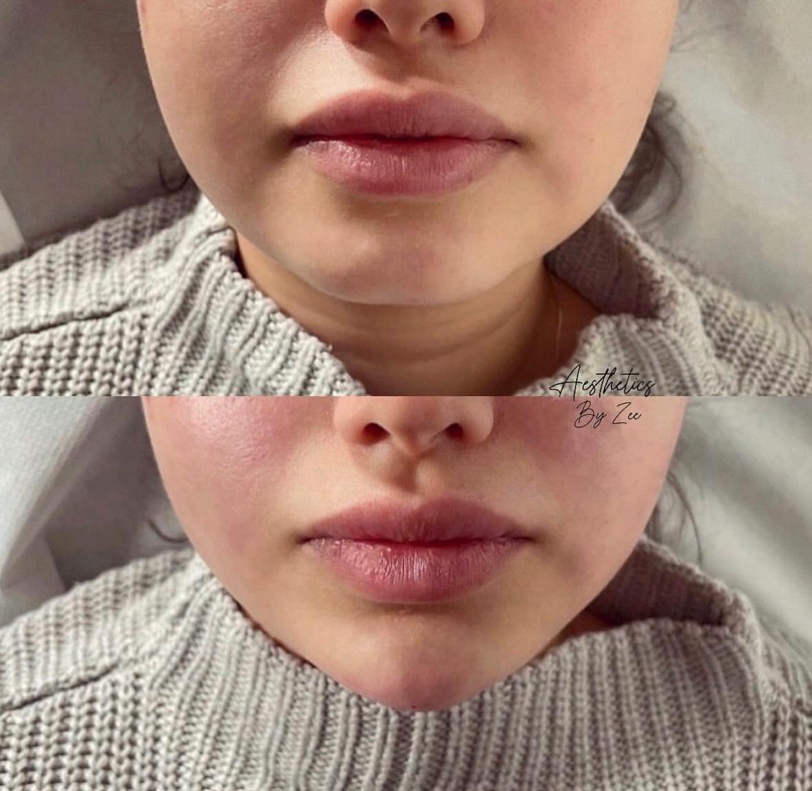 Lip Definition